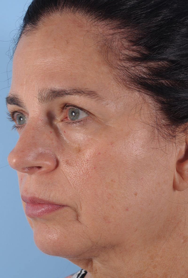 Facial Resurfacing Before & After Gallery - Patient 290607 - Image 3