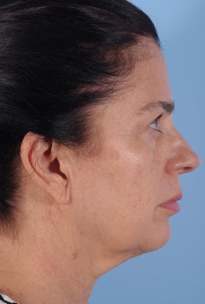 Neck Lift Before & After Gallery - Patient 132764 - Image 1