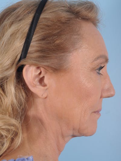 Facelift Surgery Before & After Gallery - Patient 348975 - Image 1