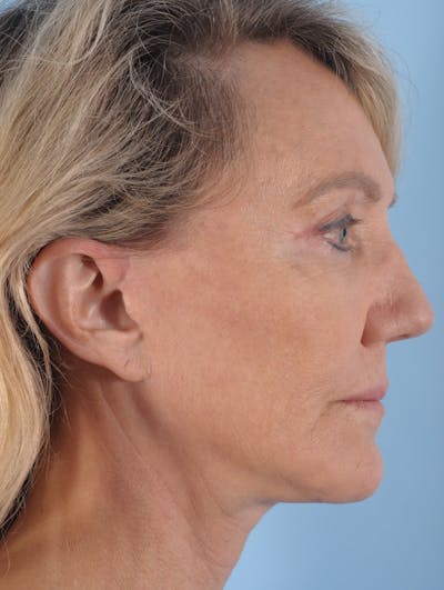 Facelift Surgery Before & After Gallery - Patient 348975 - Image 2