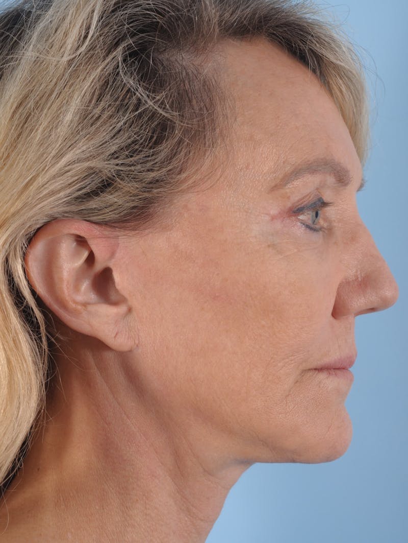 Facelift Surgery Before & After Gallery - Patient 348975 - Image 2