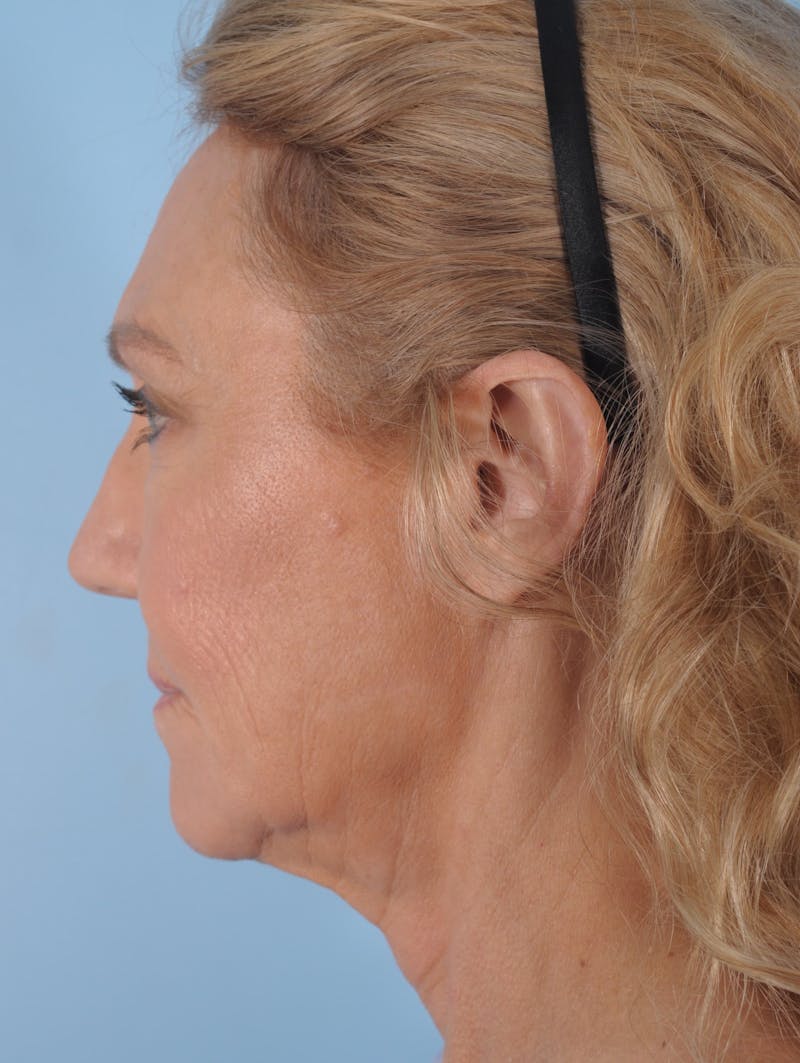 Facelift Surgery Before & After Gallery - Patient 348975 - Image 3