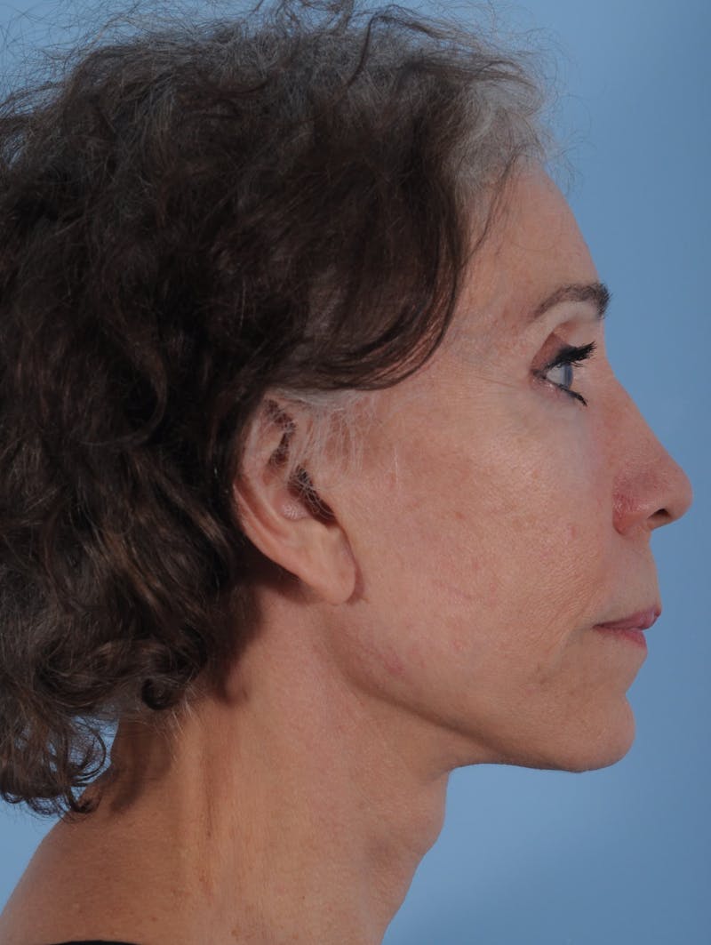 Facelift Surgery Before & After Gallery - Patient 481496 - Image 4