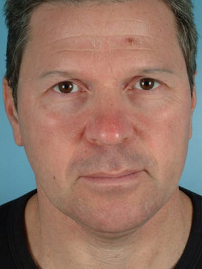Lower Blepharoplasty Before & After Gallery - Patient 210084 - Image 1