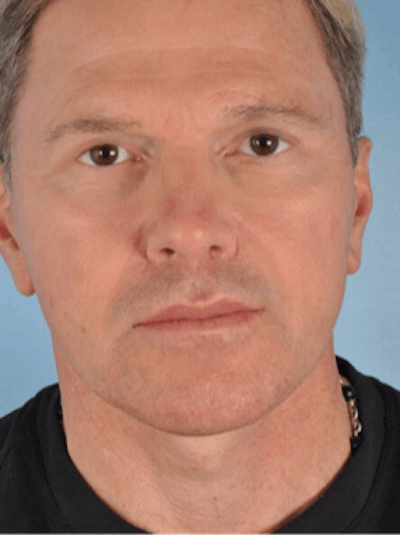 Facelift Surgery Before & After Gallery - Patient 240198 - Image 2