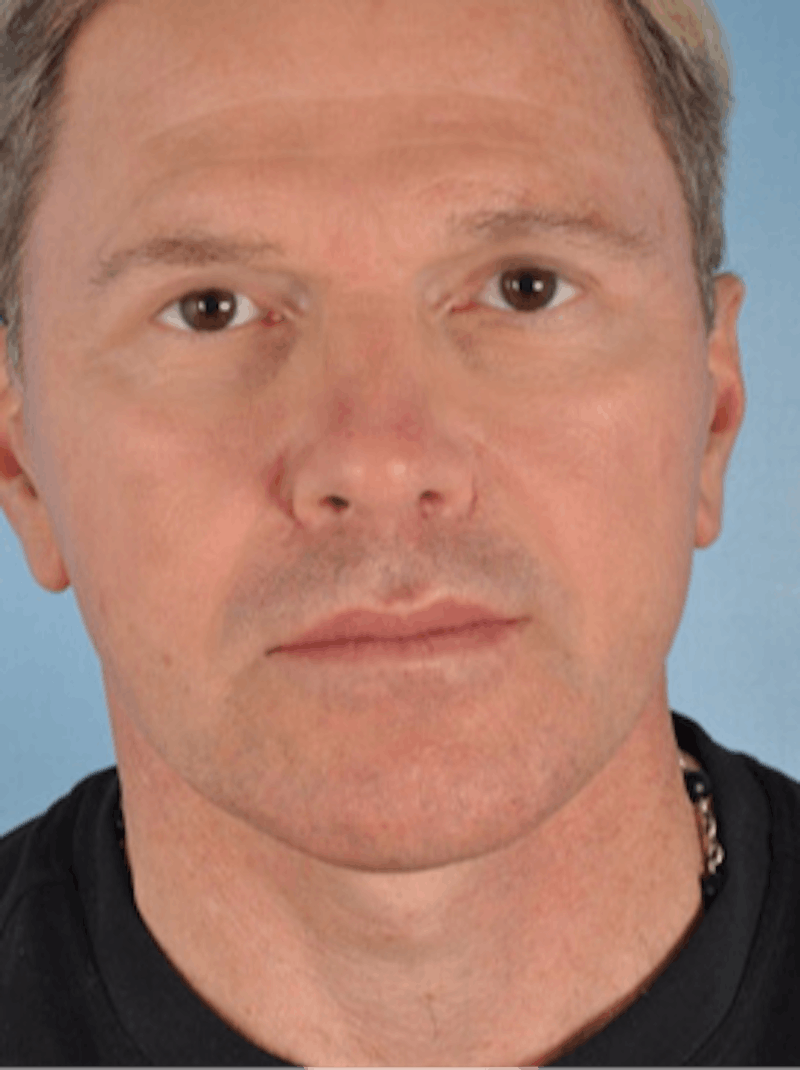 Facelift Surgery Before & After Gallery - Patient 240198 - Image 2