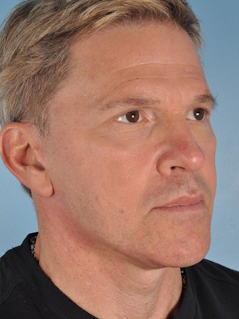 Lip Lift / Implants Before & After Gallery - Patient 124565 - Image 6