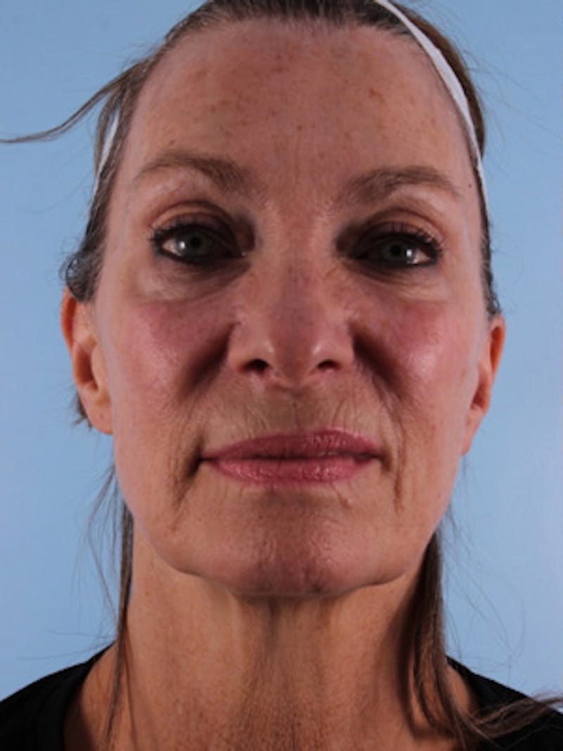 Facelift Surgery Before & After Gallery - Patient 142322 - Image 1