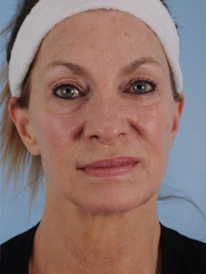 Facelift Surgery Before & After Gallery - Patient 142322 - Image 2
