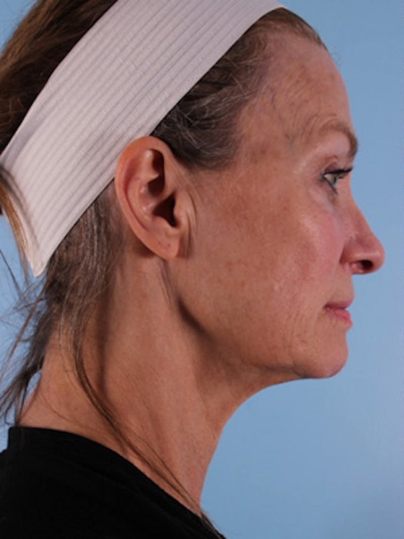 Facelift Surgery Before & After Gallery - Patient 142322 - Image 3