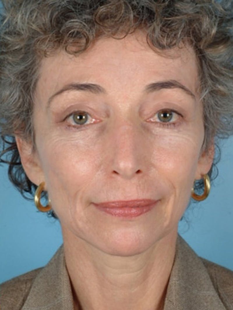 Upper Blepharoplasty Before & After Gallery - Patient 416048 - Image 2