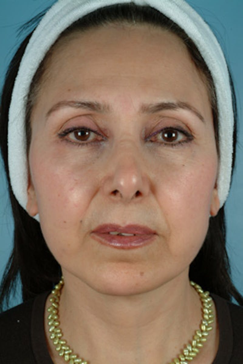Chin Implant Before & After Gallery - Patient 358748 - Image 4