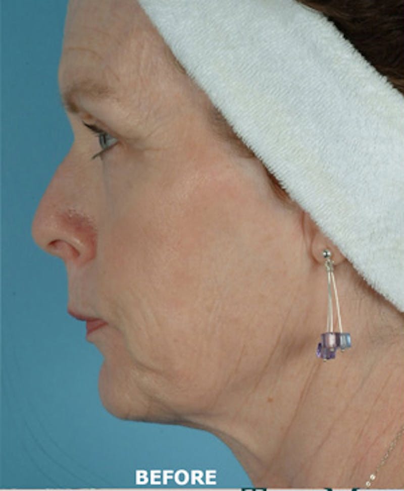 Facelift Surgery Before & After Gallery - Patient 405886 - Image 3