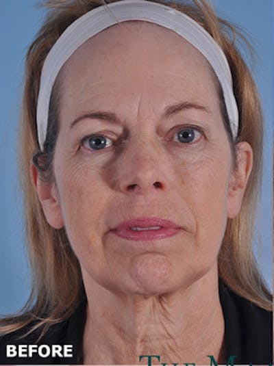 Facelift Surgery Before & After Gallery - Patient 220368 - Image 1