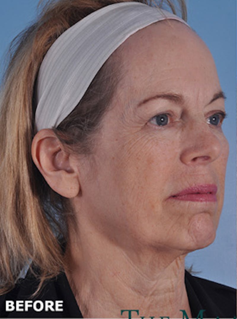 Facelift Surgery Before & After Gallery - Patient 220368 - Image 3