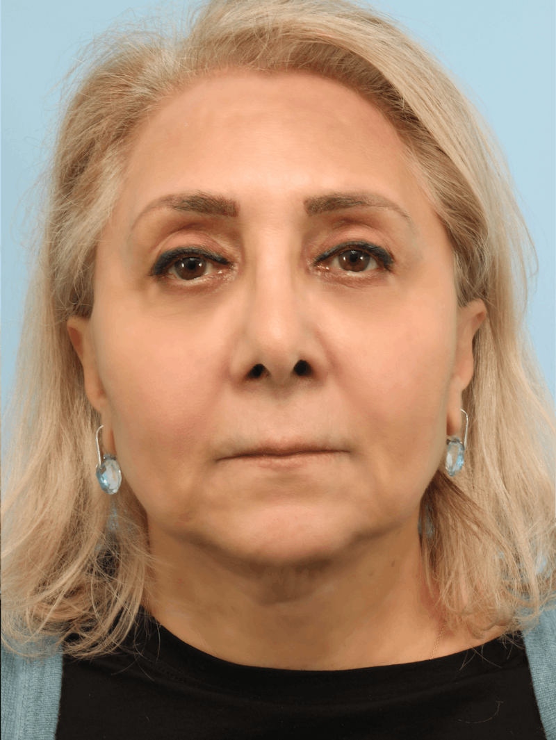 Facelift Surgery Before & After Gallery - Patient 378713 - Image 2