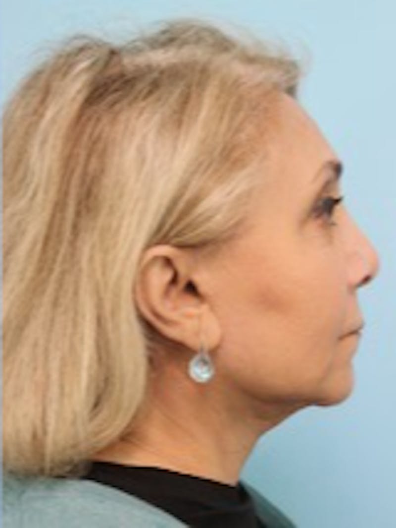 Facelift Surgery Before & After Gallery - Patient 378713 - Image 6