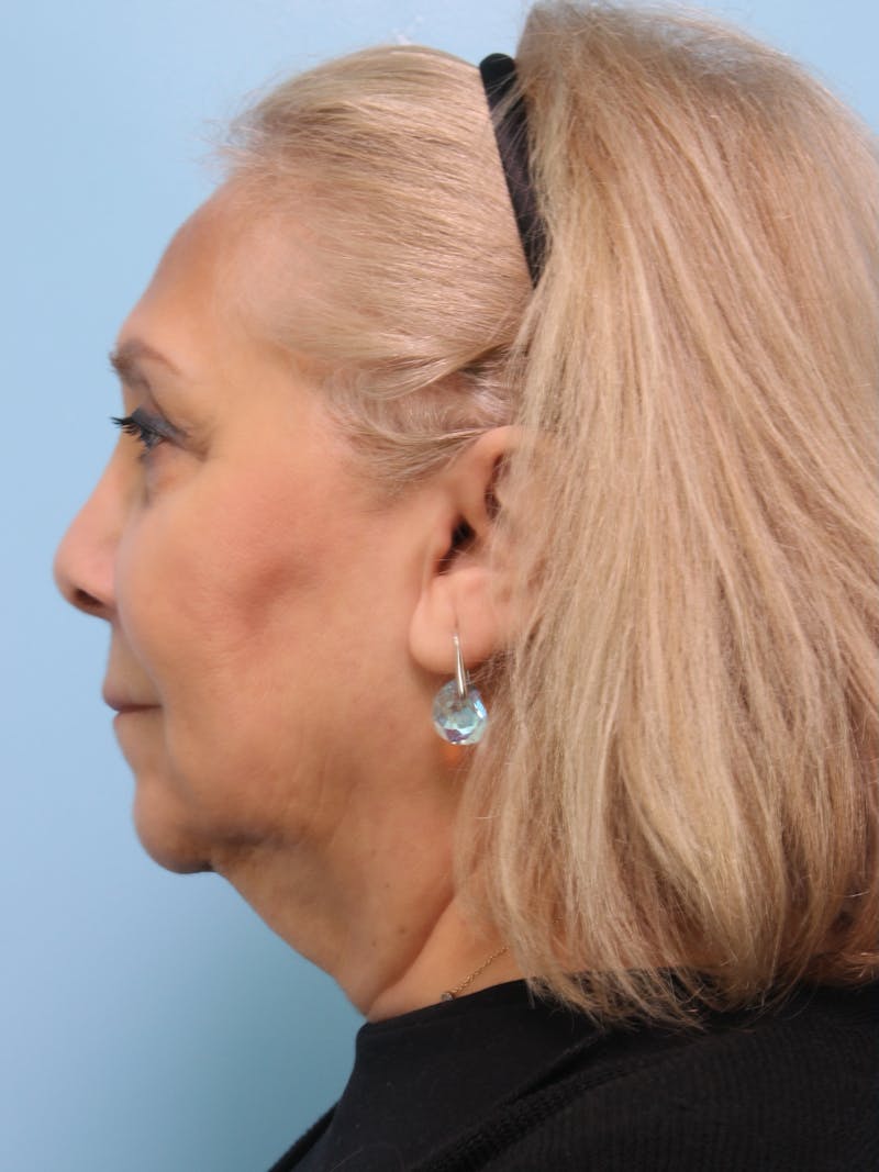 Facelift Surgery Before & After Gallery - Patient 378713 - Image 7
