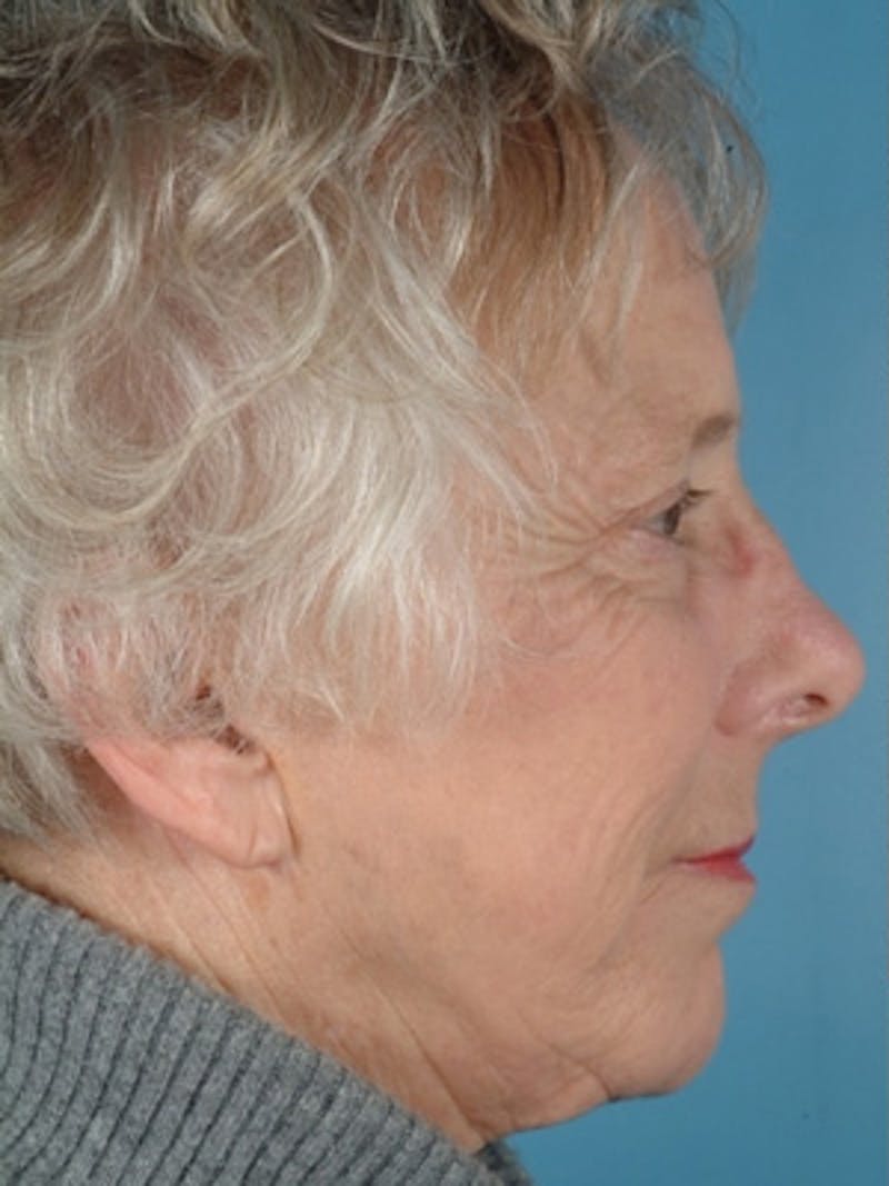 Facial Resurfacing Before & After Gallery - Patient 134871 - Image 3
