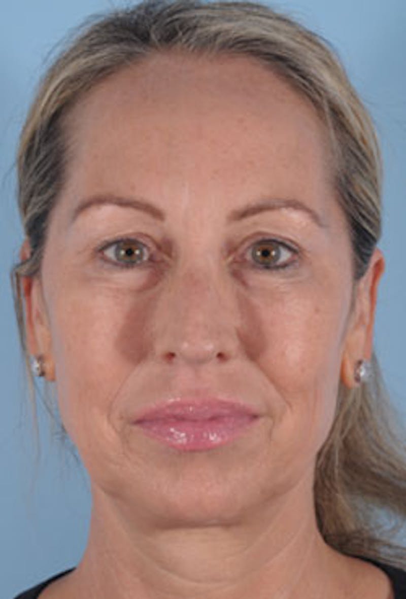 Facial Resurfacing Before & After Gallery - Patient 401002 - Image 1