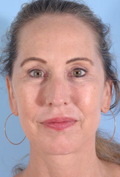 Facial Resurfacing Before & After Gallery - Patient 401002 - Image 2
