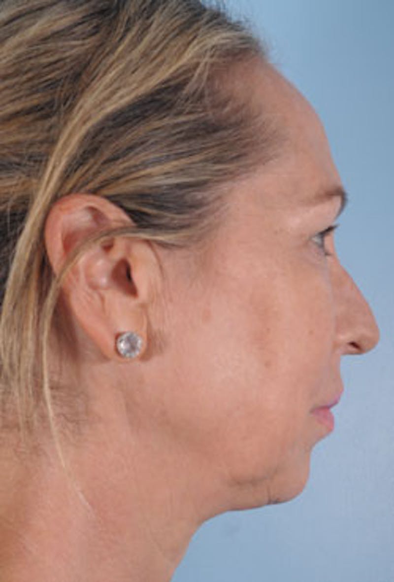 Facial Resurfacing Before & After Gallery - Patient 401002 - Image 3