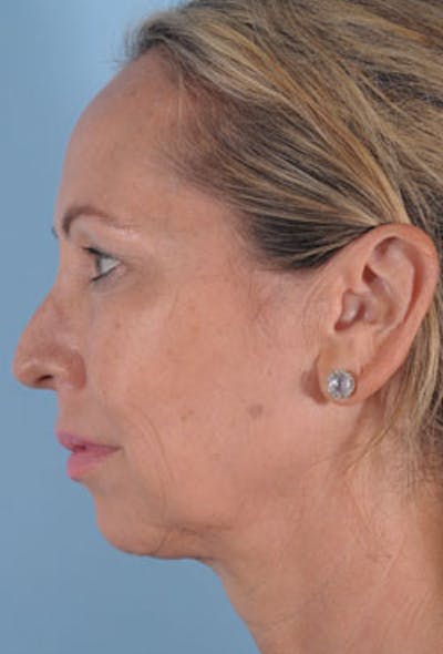 Neck Lift Before & After Gallery - Patient 427927 - Image 1