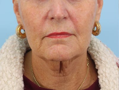 Facelift Surgery Before & After Gallery - Patient 222425 - Image 1