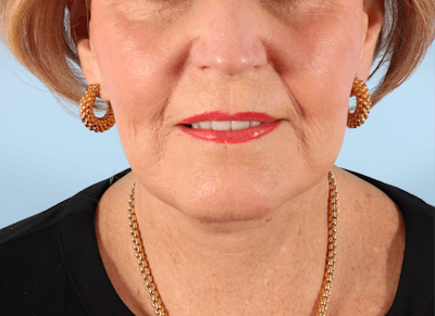 Facelift Surgery Before & After Gallery - Patient 222425 - Image 2