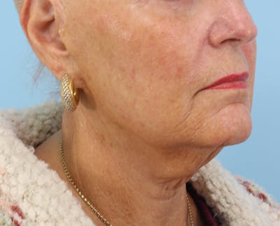 Neck Lift Before & After Gallery - Patient 100114 - Image 1