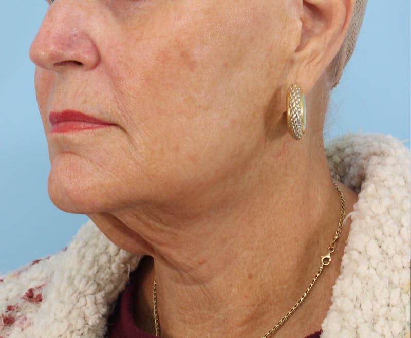 Facelift Surgery Before & After Gallery - Patient 222425 - Image 5
