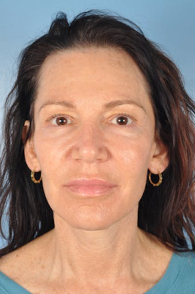 Facelift Surgery Before & After Gallery - Patient 268593 - Image 2