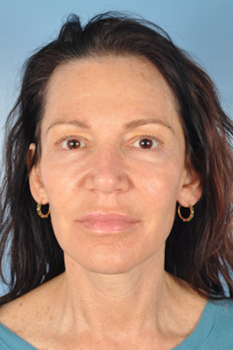 Facelift Surgery Before & After Gallery - Patient 268593 - Image 2