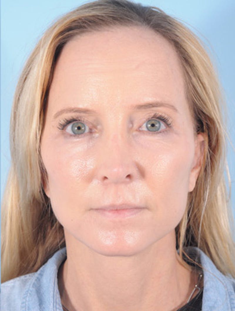 Facelift Surgery Before & After Gallery - Patient 145950 - Image 2
