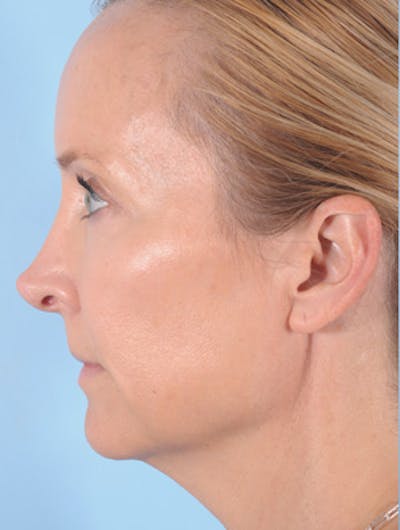 Neck Lift Before & After Gallery - Patient 170173 - Image 1