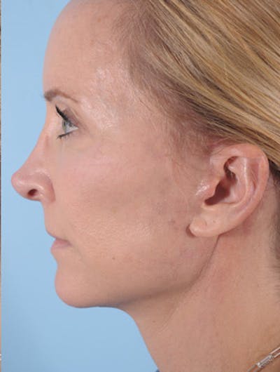 Neck Lift Before & After Gallery - Patient 170173 - Image 2