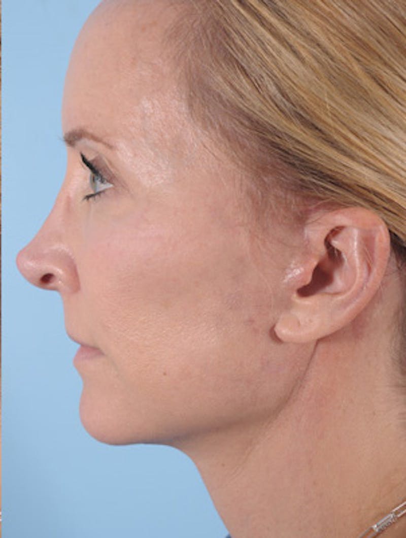 Facelift Surgery Before & After Gallery - Patient 145950 - Image 4