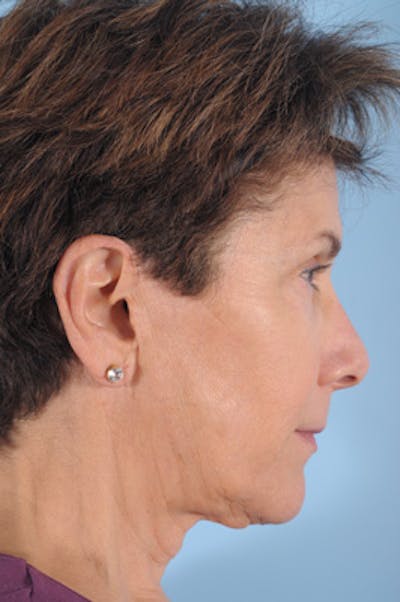 Neck Lift Before & After Gallery - Patient 123497 - Image 1