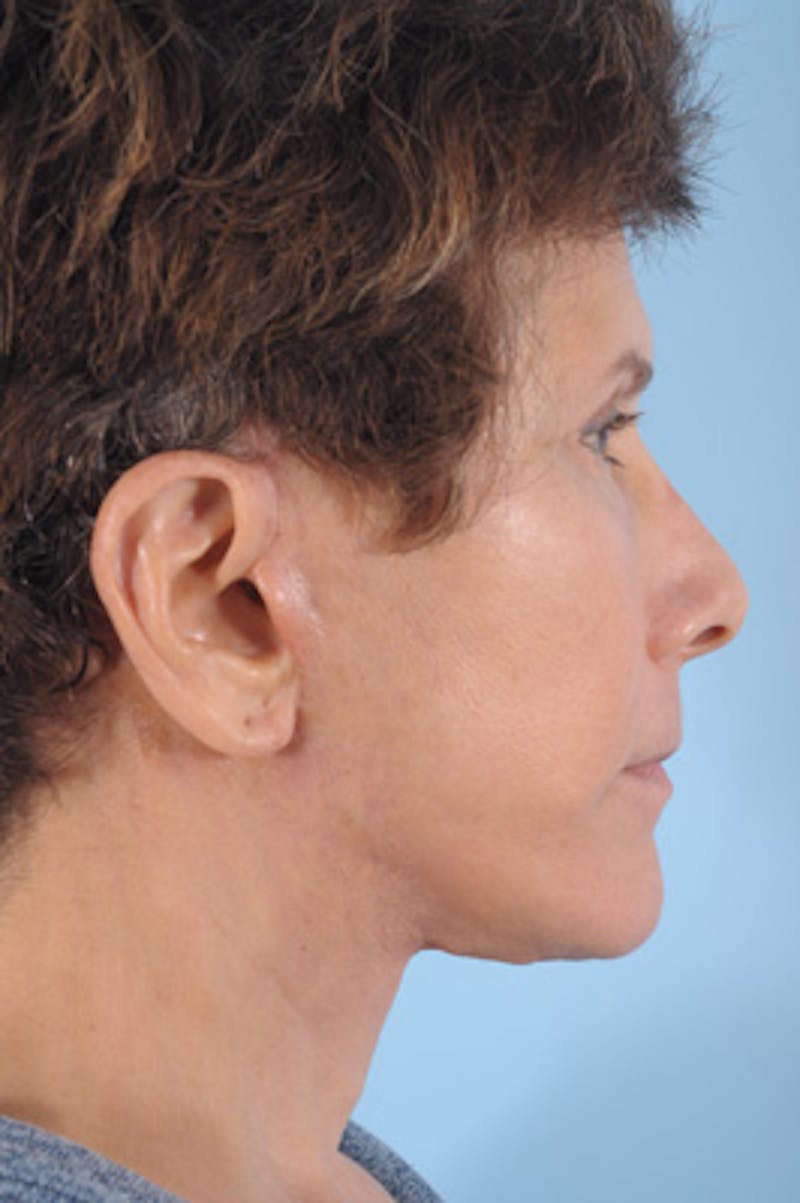 Facial Resurfacing Before & After Gallery - Patient 372891 - Image 6