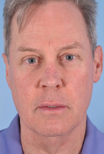 IPL Photofacial Before & After Gallery - Patient 424396 - Image 1