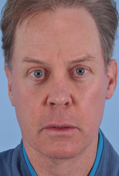 IPL Photofacial Before & After Gallery - Patient 424396 - Image 2