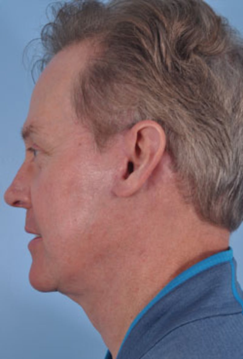 Facelift Surgery Before & After Gallery - Patient 223907 - Image 4