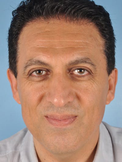 Lower Blepharoplasty Before & After Gallery - Patient 276286 - Image 1