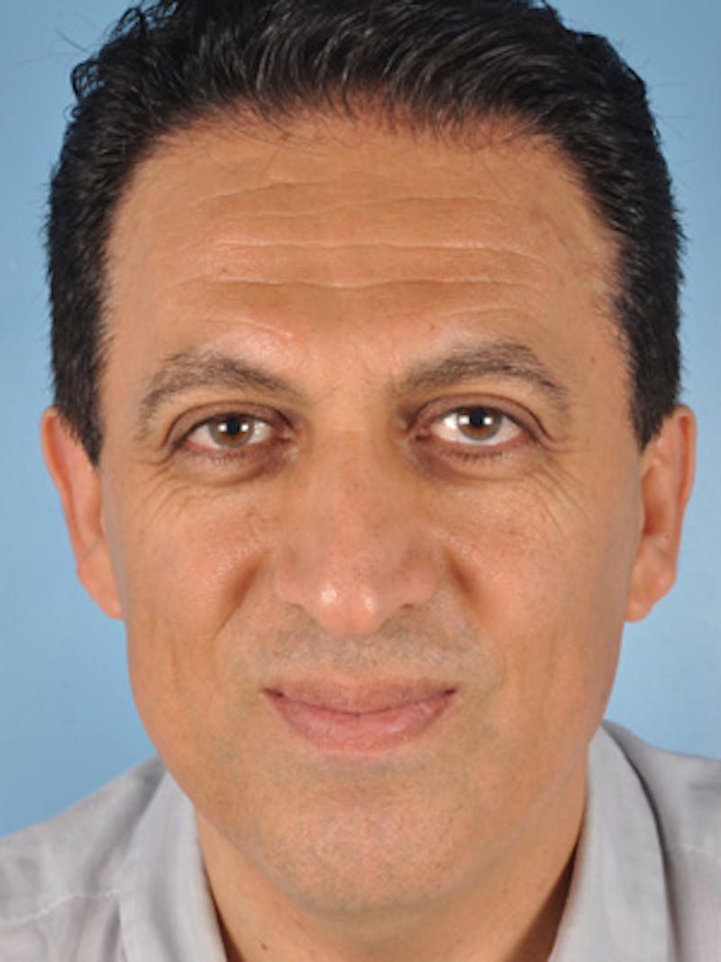 Rhinoplasty Before & After Gallery - Patient 377419 - Image 3