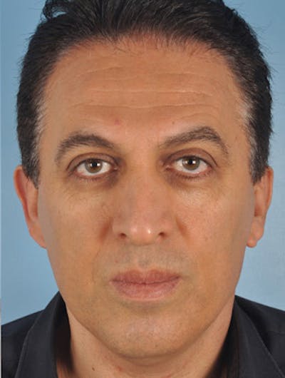 Lower Blepharoplasty Before & After Gallery - Patient 276286 - Image 2