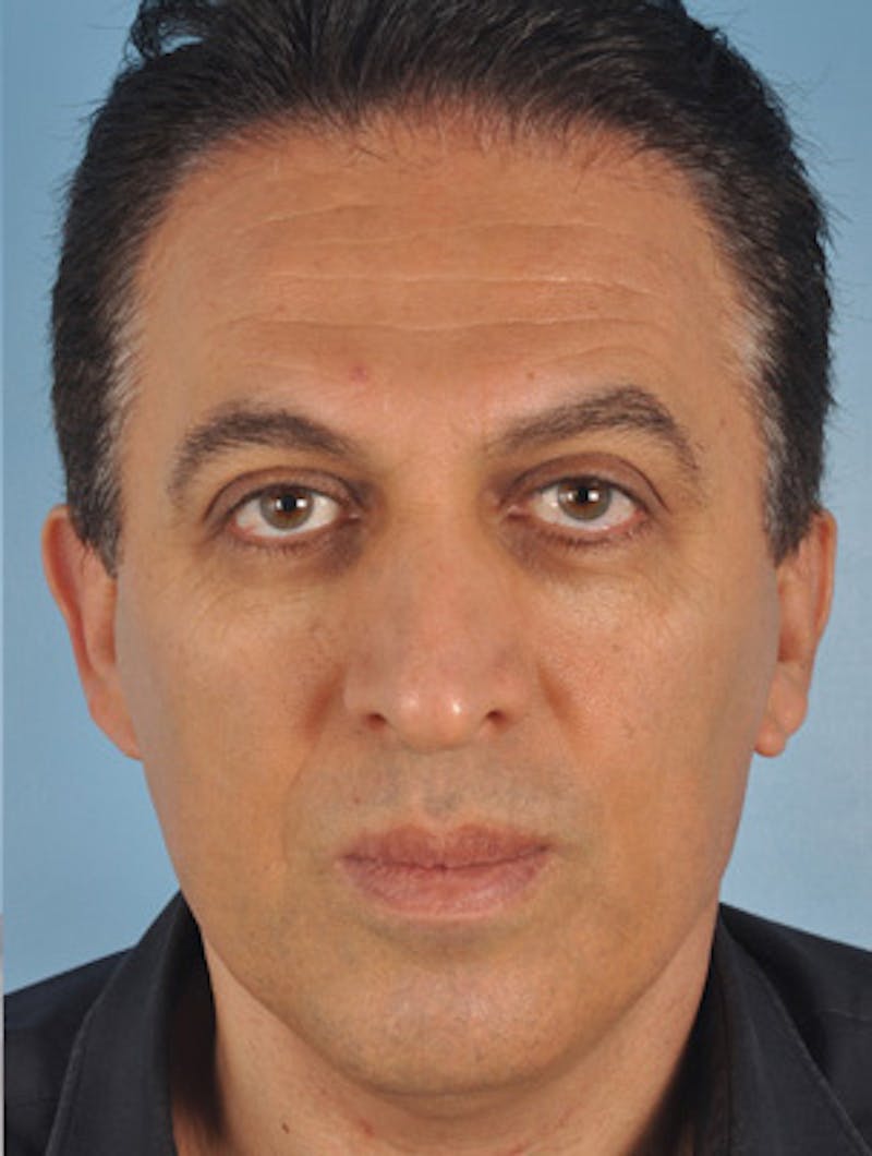 Rhinoplasty Before & After Gallery - Patient 377419 - Image 4