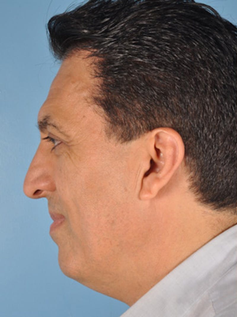 Rhinoplasty Before & After Gallery - Patient 377419 - Image 1