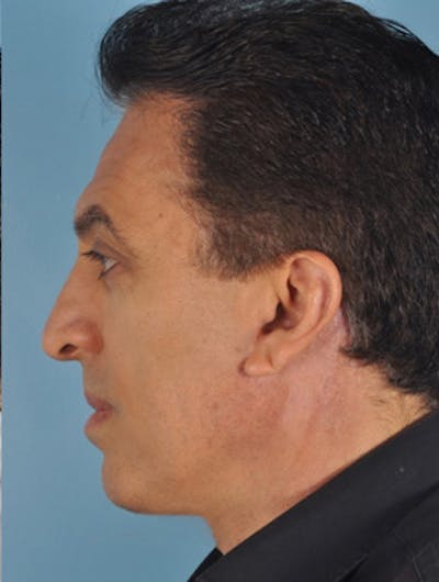 Rhinoplasty Before & After Gallery - Patient 377419 - Image 2