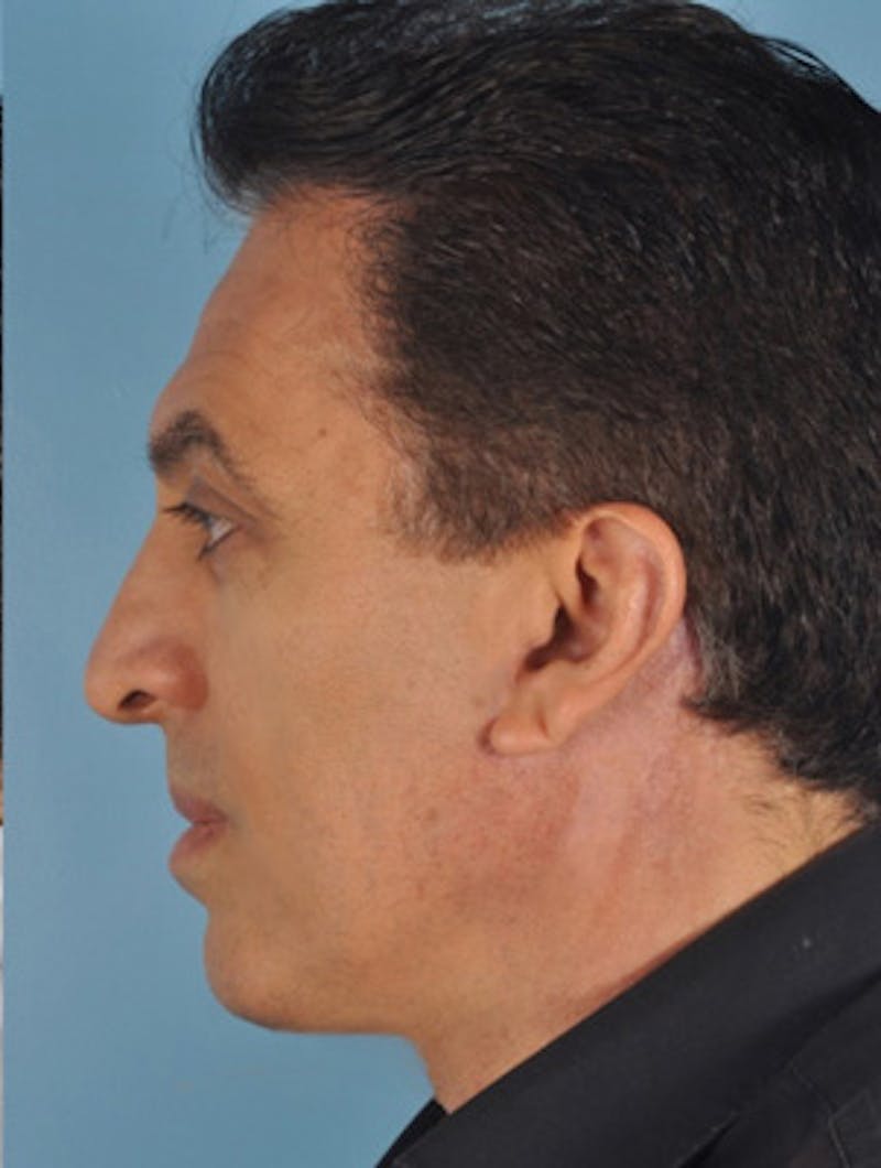 Rhinoplasty Before & After Gallery - Patient 377419 - Image 2