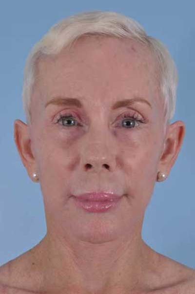 Facelift Surgery Before & After Gallery - Patient 245455 - Image 2